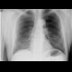Rib fracture: X-ray - Plain radiograph